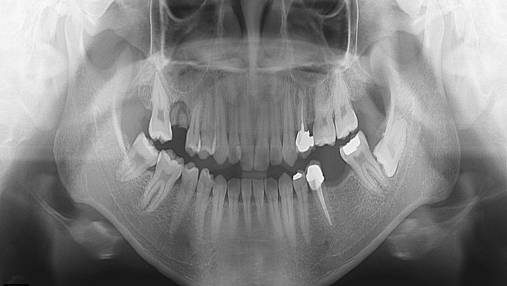파노라마 X-ray 상담 데모